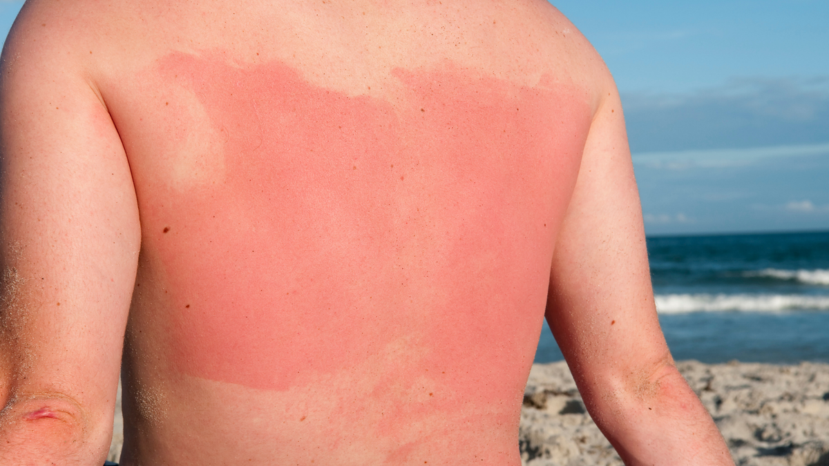 Kulit Terbakar Matahari (Sunburn)? Begini Cara Merawatnya agar Cepat Pulih