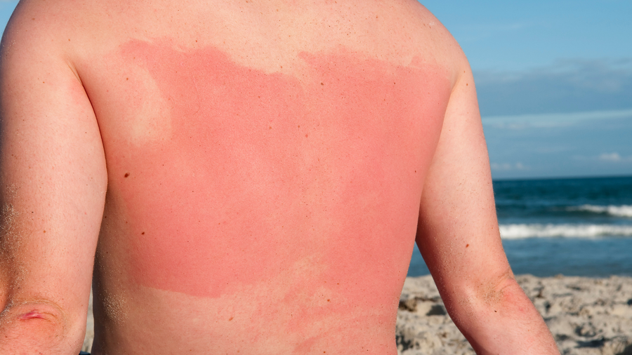 Kulit Terbakar Matahari (Sunburn)? Begini Cara Merawatnya agar Cepat Pulih